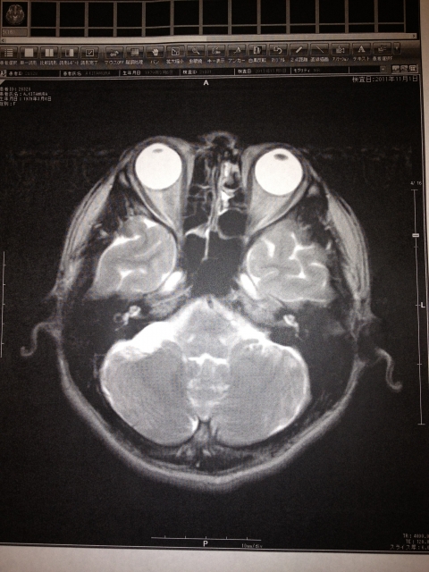 脳震盪とは 正しい応急処置で後遺症を防ごう 児童向けコラム 障害者ドットコム